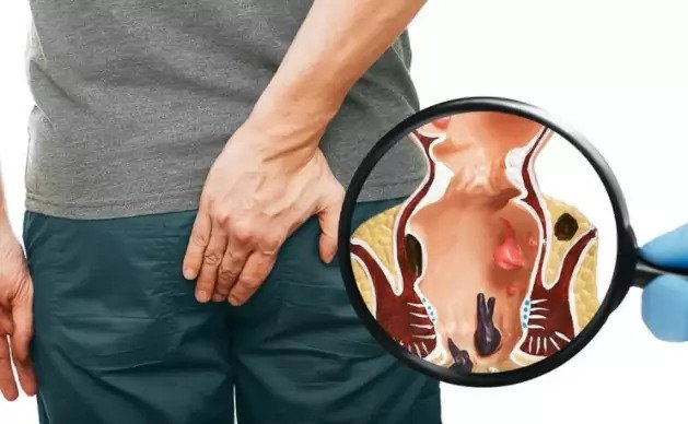 piles treatment